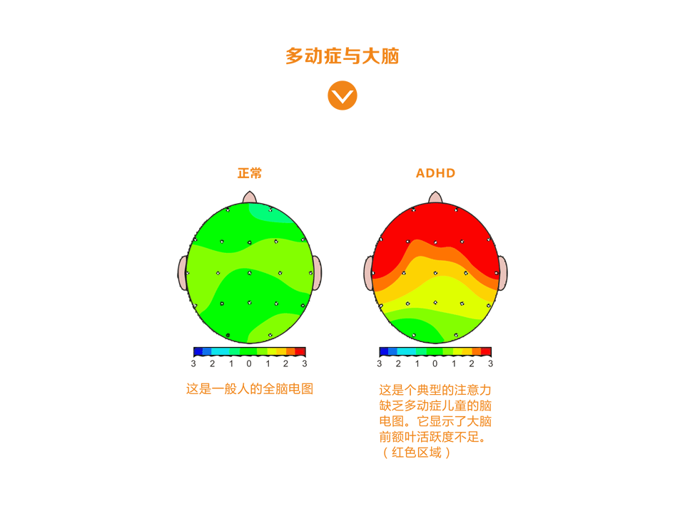 多动症与大脑